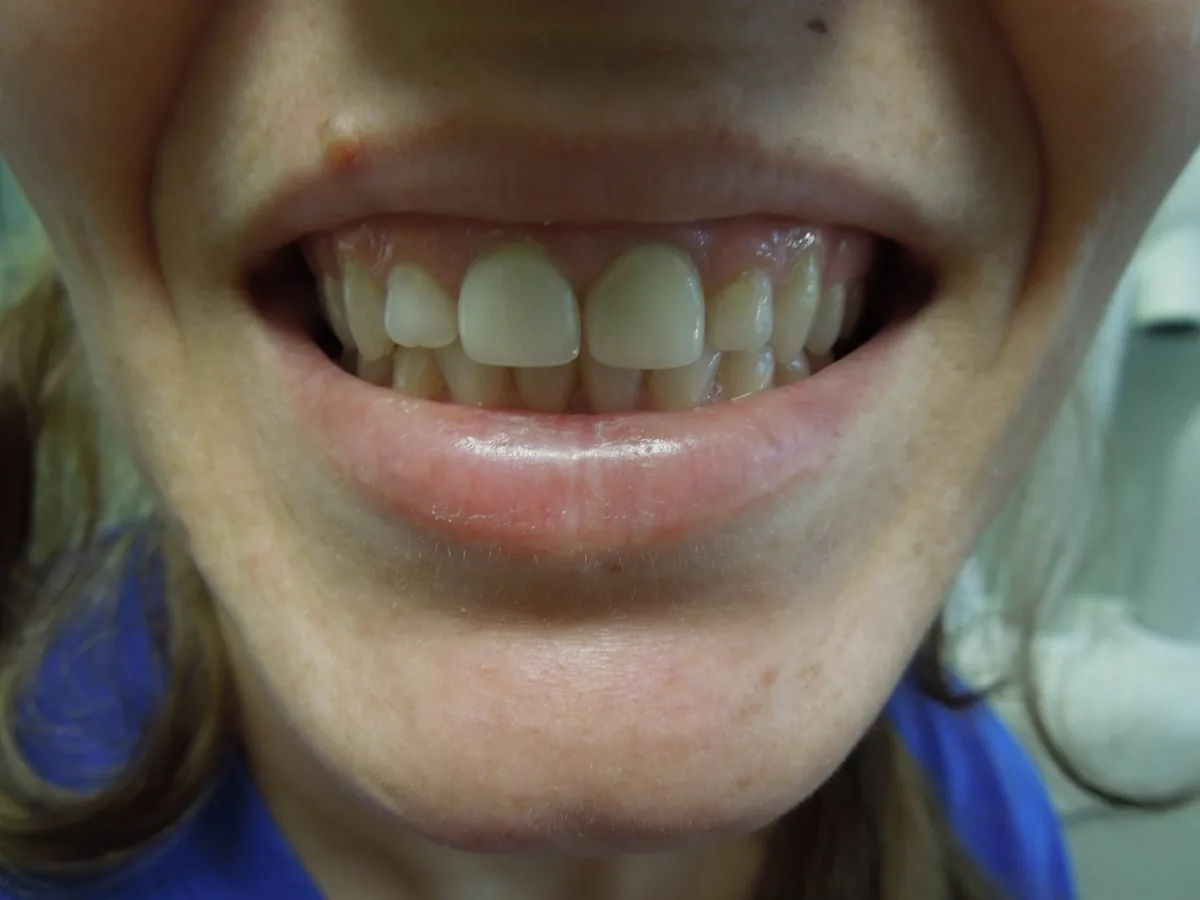 The same patient's teeth after treatment at Dynamic Dental Arts, case 14