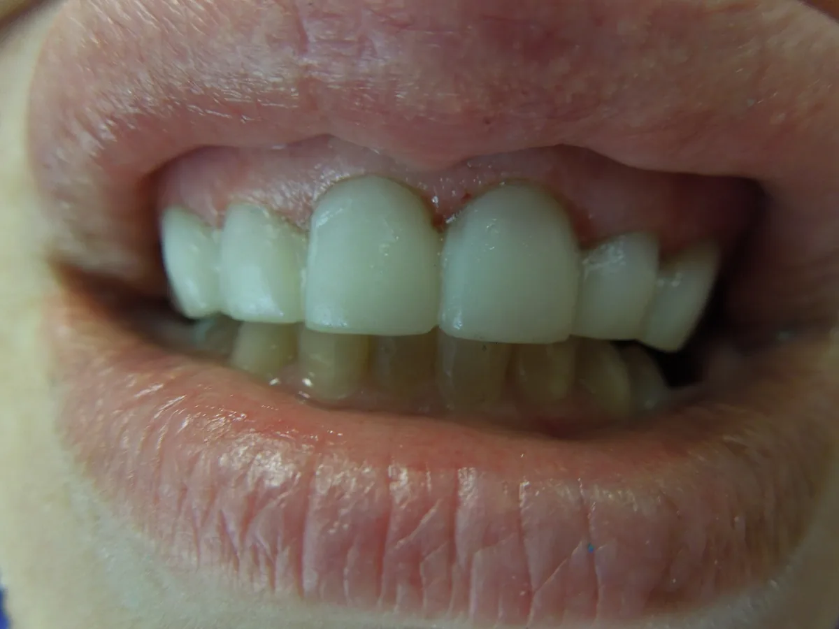 The same patient's teeth after treatment at Dynamic Dental Arts, case 13