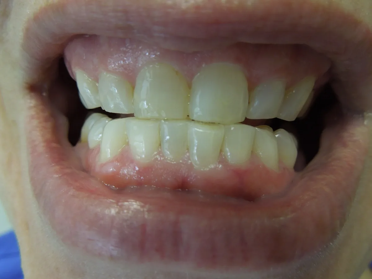 Close-up of a patient's teeth before treatment at Dynamic Dental Arts, case 13