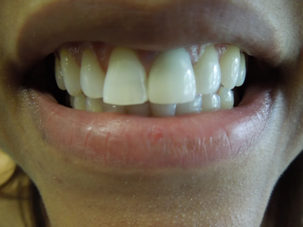 The same patient's teeth after treatment at Dynamic Dental Arts, case 15