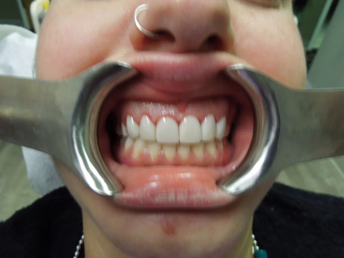 The same patient's teeth after treatment at Dynamic Dental Arts, case 07