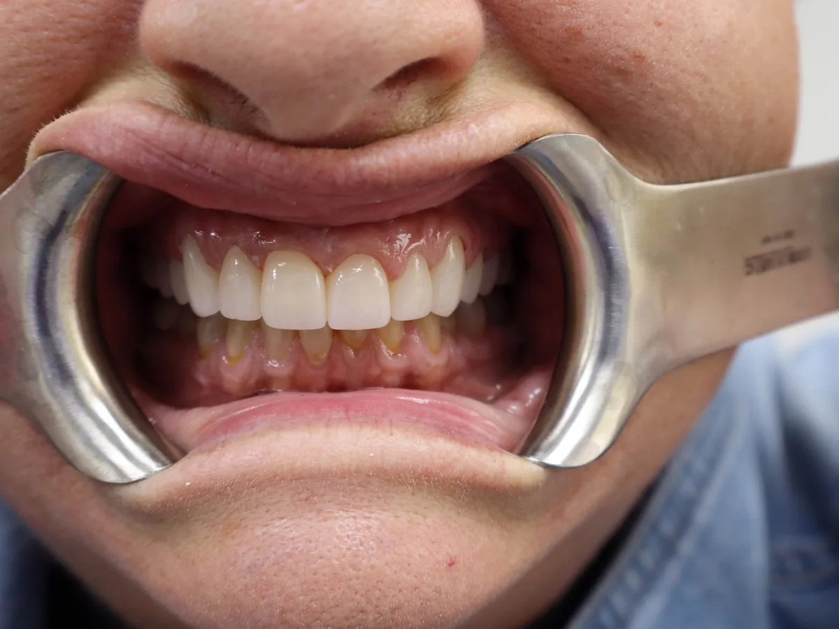 The same patient's teeth after treatment at Dynamic Dental Arts, case 11