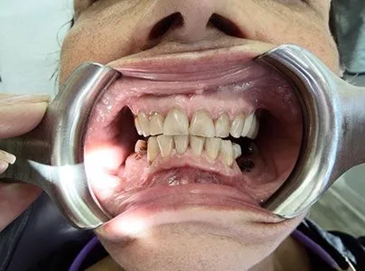 Close-up of a patient's teeth before treatment at Dynamic Dental Arts, case 06
