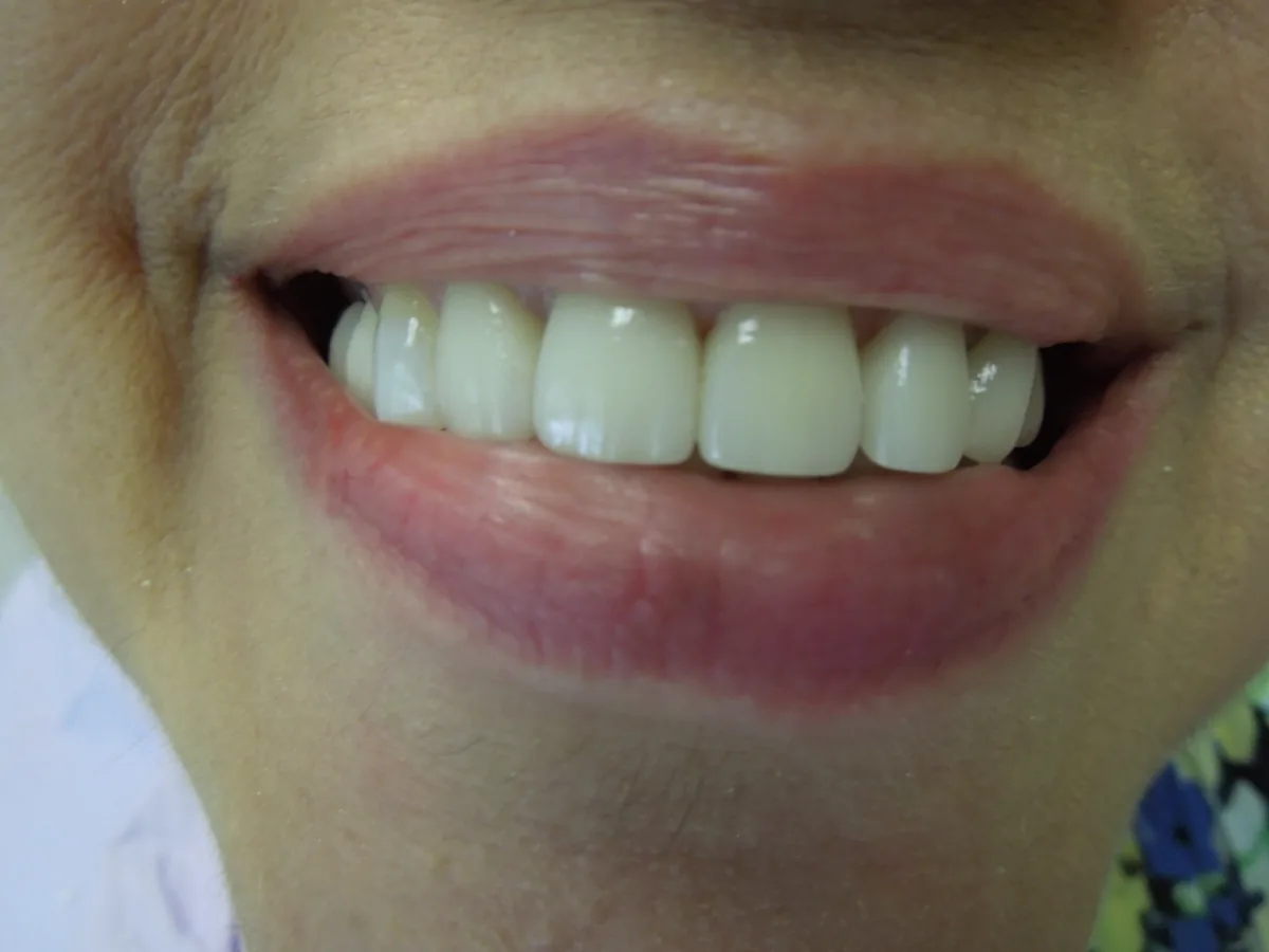 The same patient's teeth after treatment at Dynamic Dental Arts, case 12
