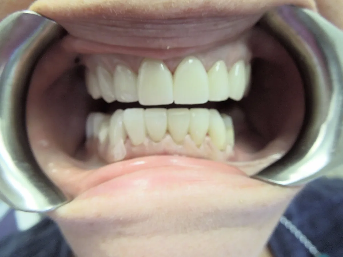 The same patient's teeth after treatment at Dynamic Dental Arts, case 02