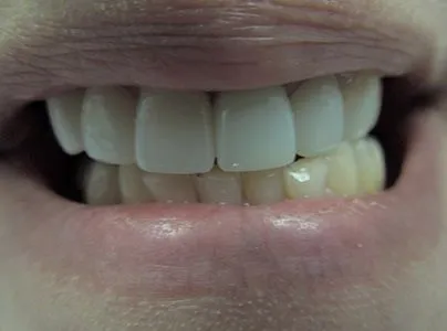 The same patient's teeth after treatment at Dynamic Dental Arts, case 04