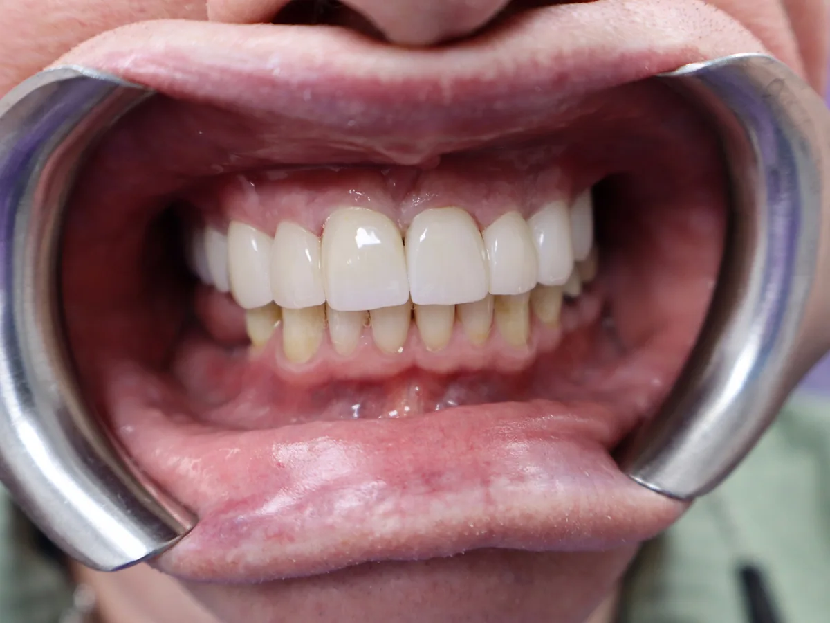 The same patient's teeth after treatment at Dynamic Dental Arts, case 08