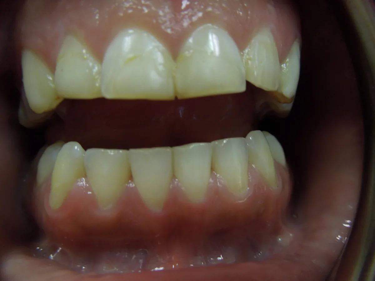 Close-up of a patient's teeth before treatment at Dynamic Dental Arts, case 07