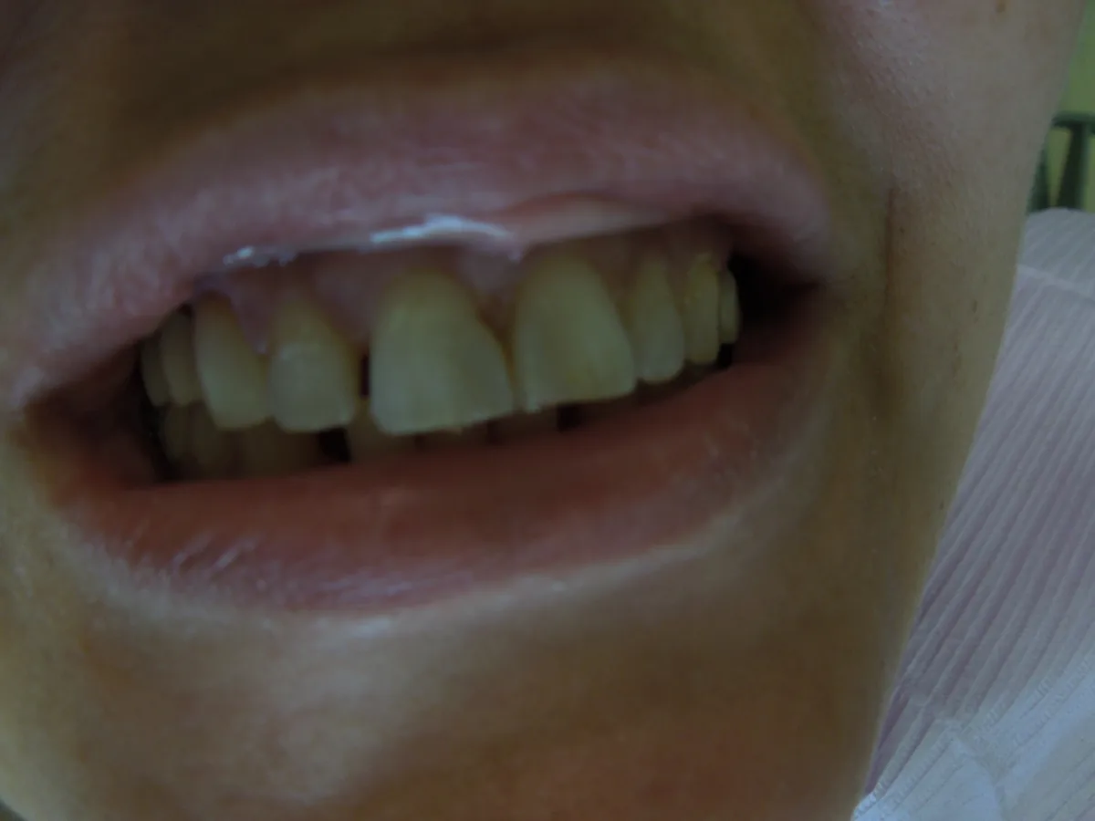Close-up of a patient's teeth before treatment at Dynamic Dental Arts, case 12
