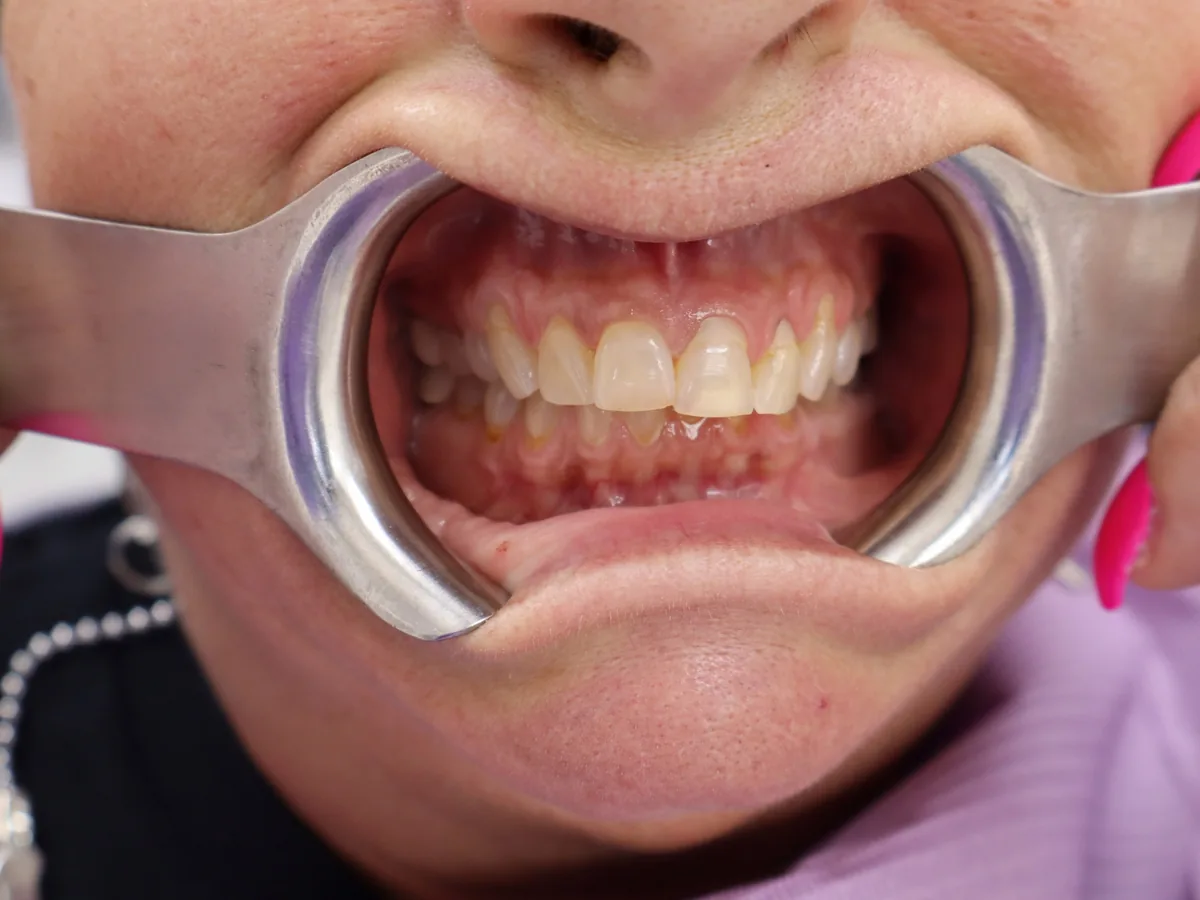 Close-up of a patient's teeth before treatment at Dynamic Dental Arts, case 11