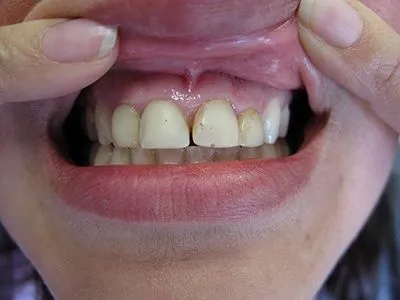 Close-up of a patient's teeth before treatment at Dynamic Dental Arts, case 03