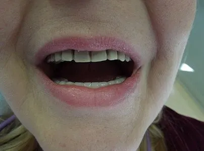 Close-up of a patient's teeth before treatment at Dynamic Dental Arts, case 05