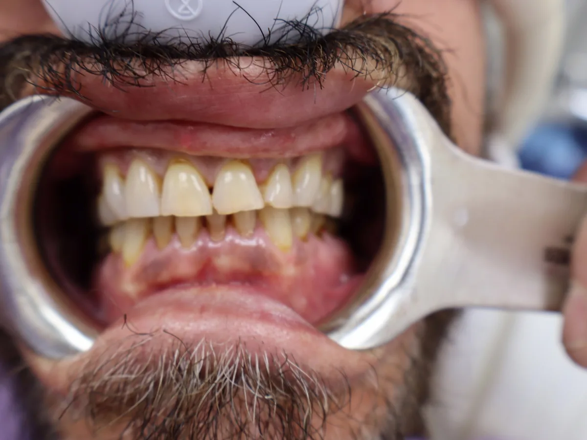 Close-up of a patient's teeth before treatment at Dynamic Dental Arts, case 10