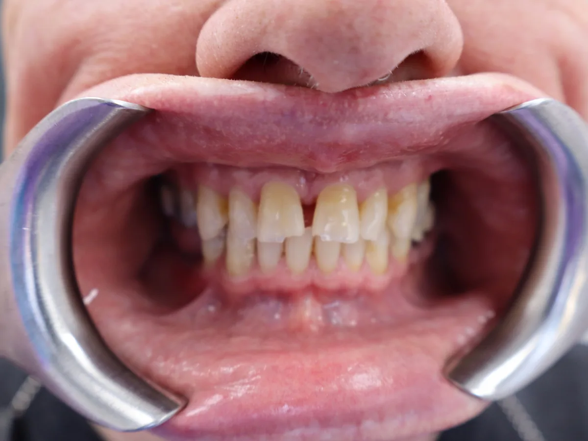 Close-up of a patient's teeth before treatment at Dynamic Dental Arts, case 08