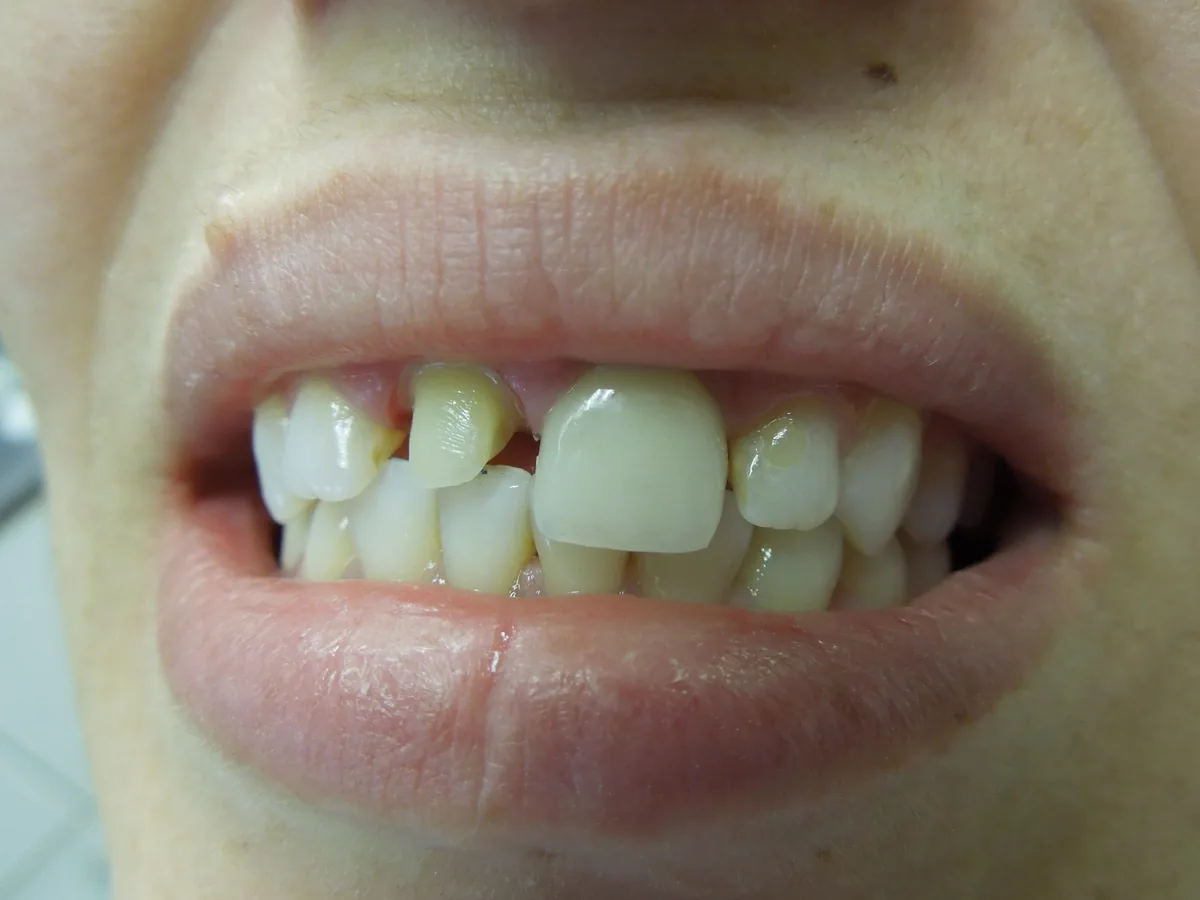 Close-up of a patient's teeth before treatment at Dynamic Dental Arts, case 14