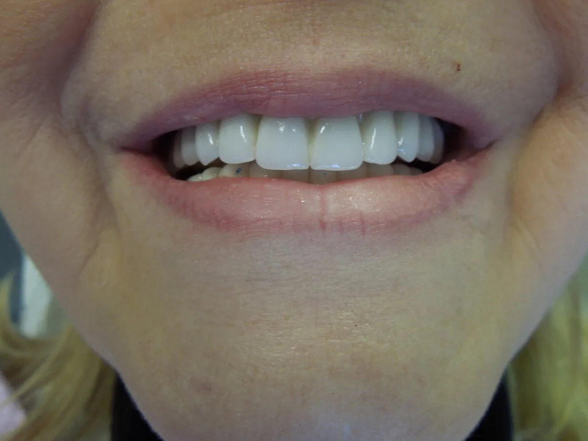 The same patient's teeth after treatment at Dynamic Dental Arts, case 01