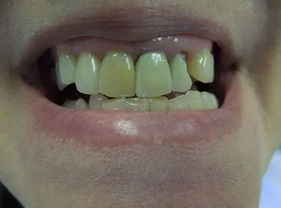 Close-up of a patient's teeth before treatment at Dynamic Dental Arts, case 04