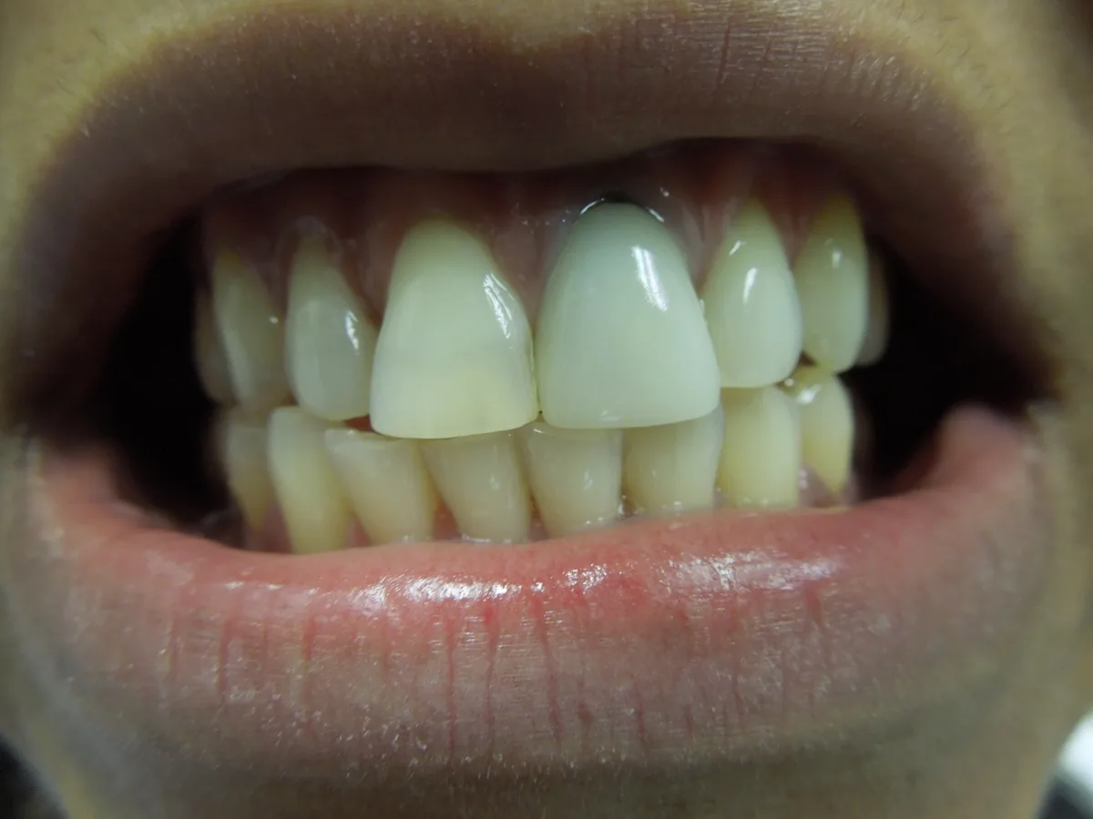 Close-up of a patient's teeth before treatment at Dynamic Dental Arts, case 15