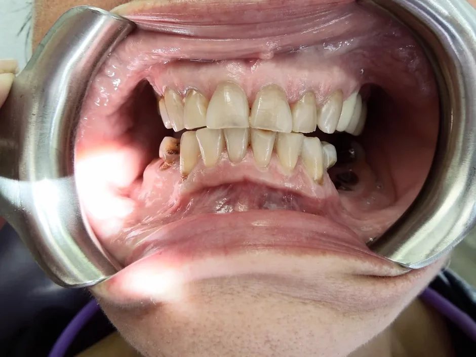 A patient's teeth before treatment at Dynamic Dental Arts, case 02